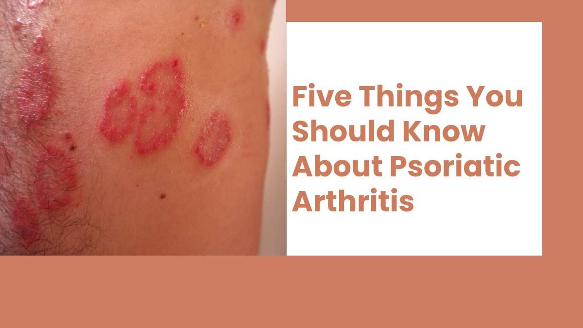 Five Things You Should Know About Psoriatic Arthritis