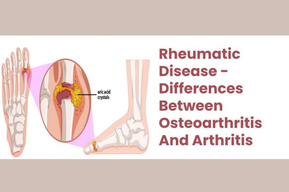 Rheumatic Disease - Differences Between Osteoarthritis And Arthritis