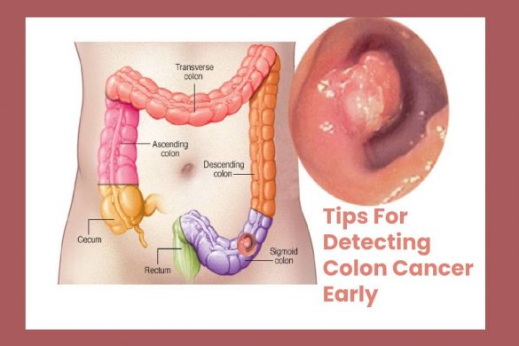 Tips For Detecting Colon Cancer Early