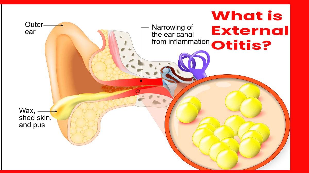 What Does Otitis Externa Mean? – ORSJO