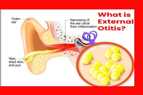 What is External Otitis? Causes And Its Types And Symptoms