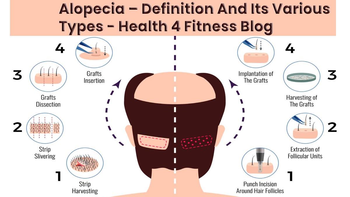 Alopecia – Definition And Its Various Types