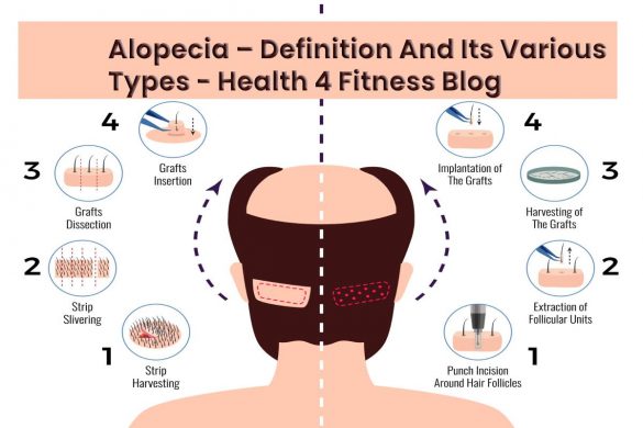 Alopecia – Definition And Its Various Types - Health 4 Fitness Blog