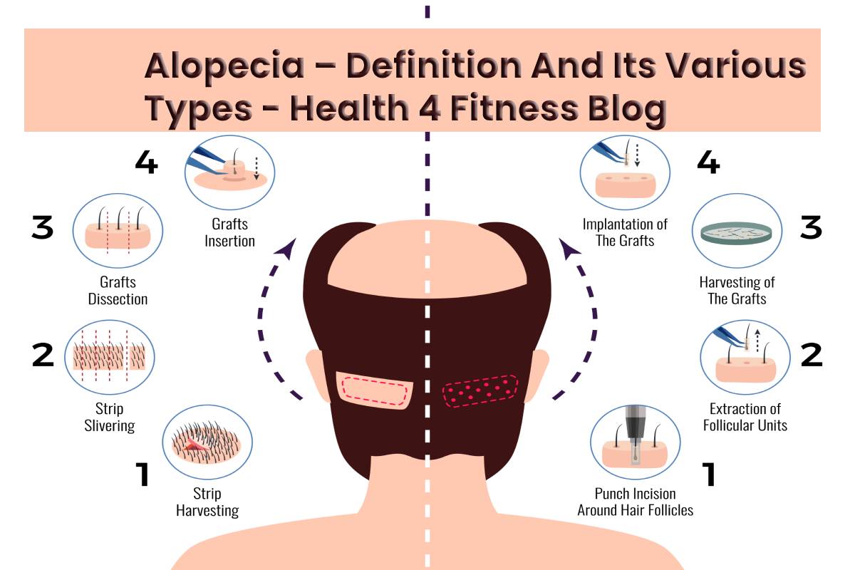 Alopecia define Alopecia Definition