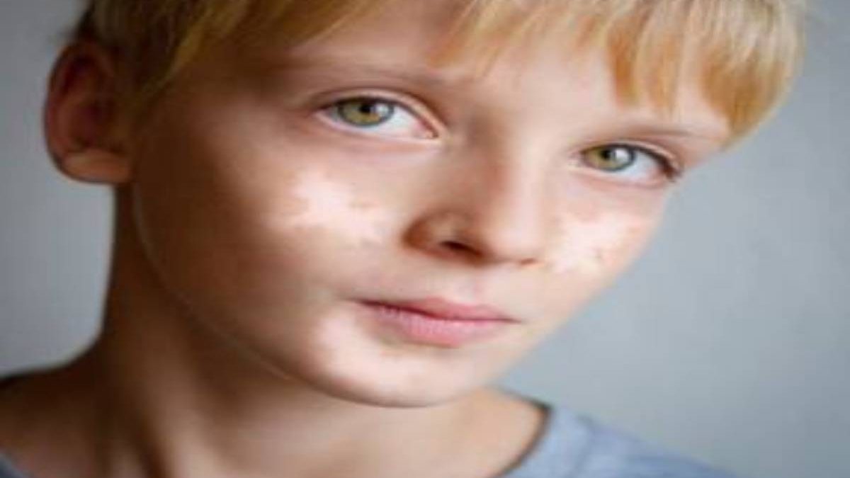 Vitiligo In Children: Tips To Consider - Health4Fitness