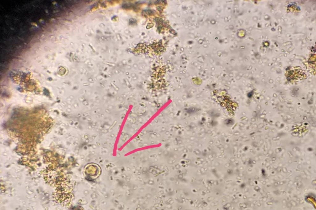 Blastocystis Hominis
