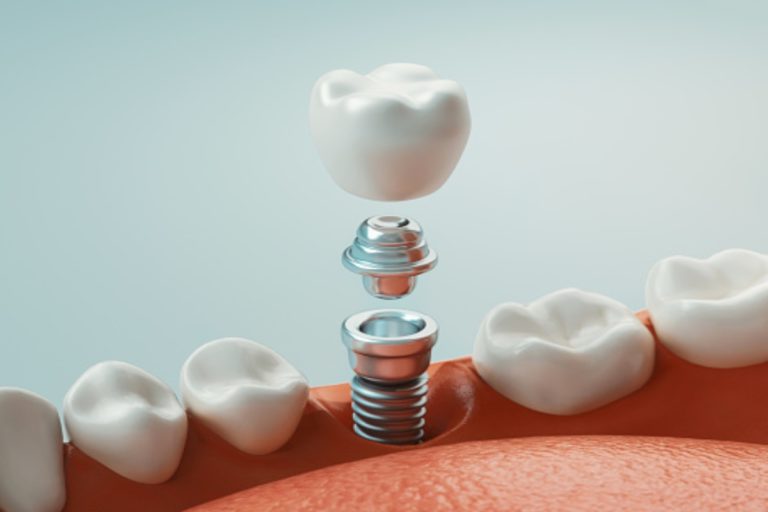 10 Impressive Benefits of Dental Implants