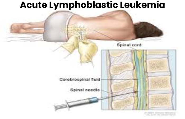 Acute Lymphoblastic Leukemia Write For Us