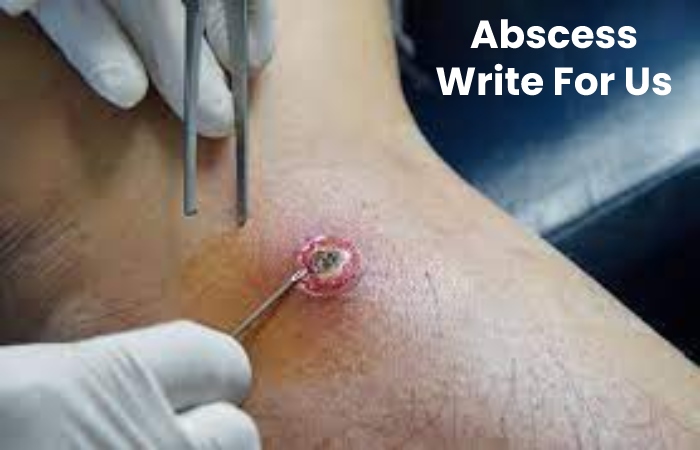 Abscess Write For Us