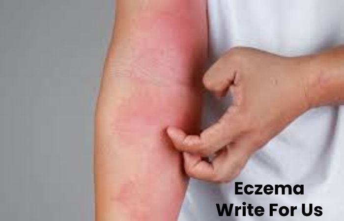 Eczema Write For Us