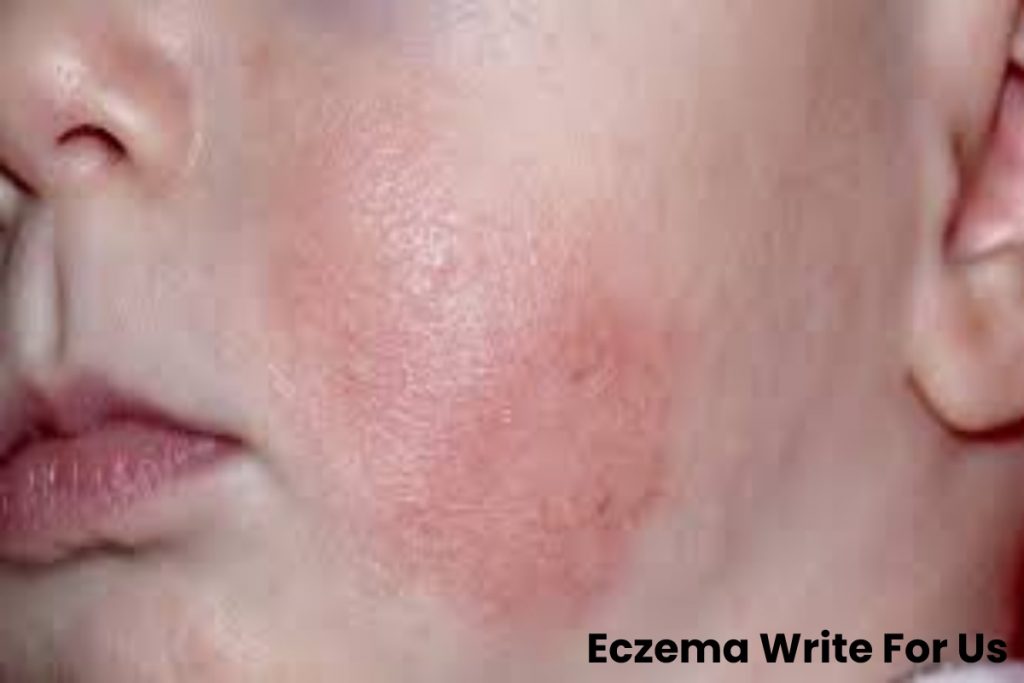 Eczema Write For Us