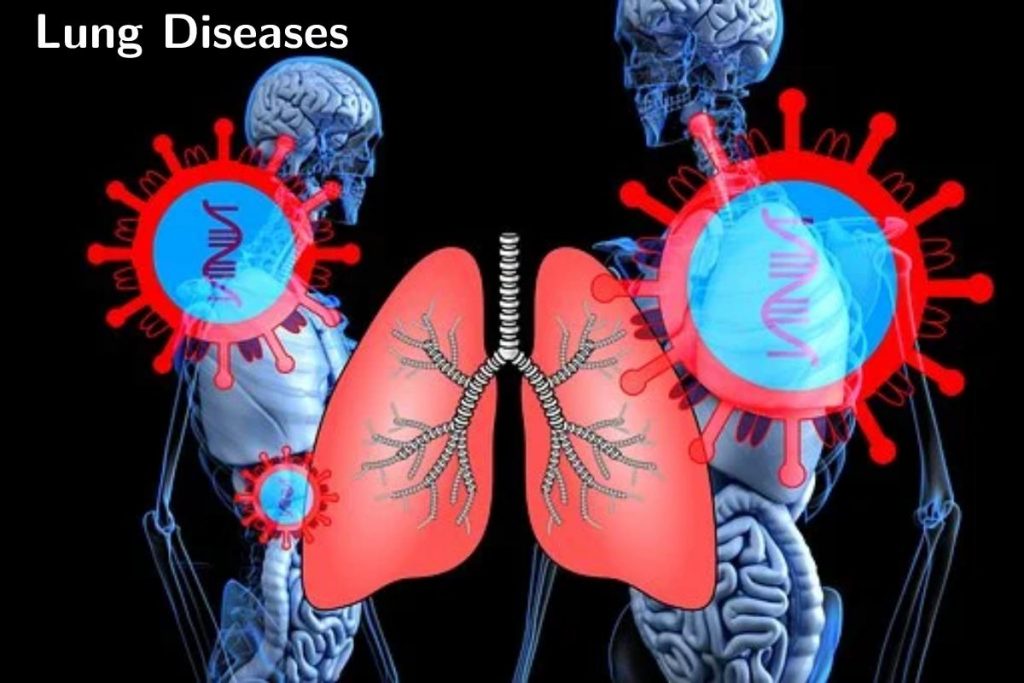 Lung Diseases Write For Us