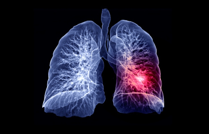 Lung Diseases Write For Us