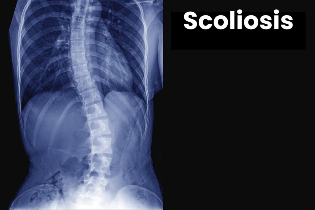 Scoliosis Write For Us