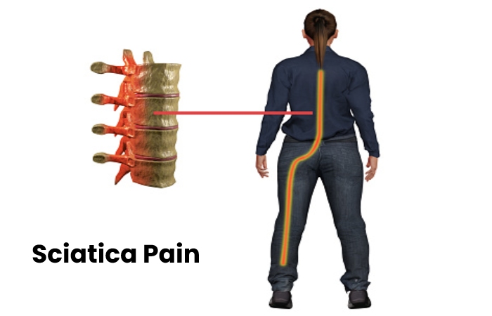 Sciatica Pain Write For Us