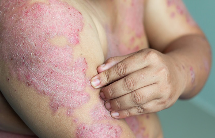Psoriasis Write For Us