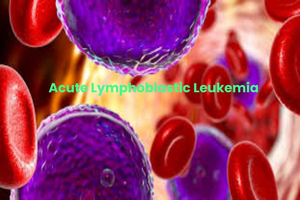 Acute Lymphoblastic Leukemia Write For Us