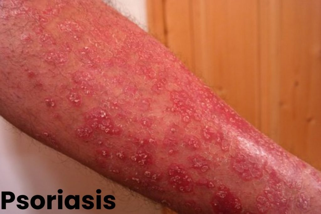 Psoriasis Write For Us