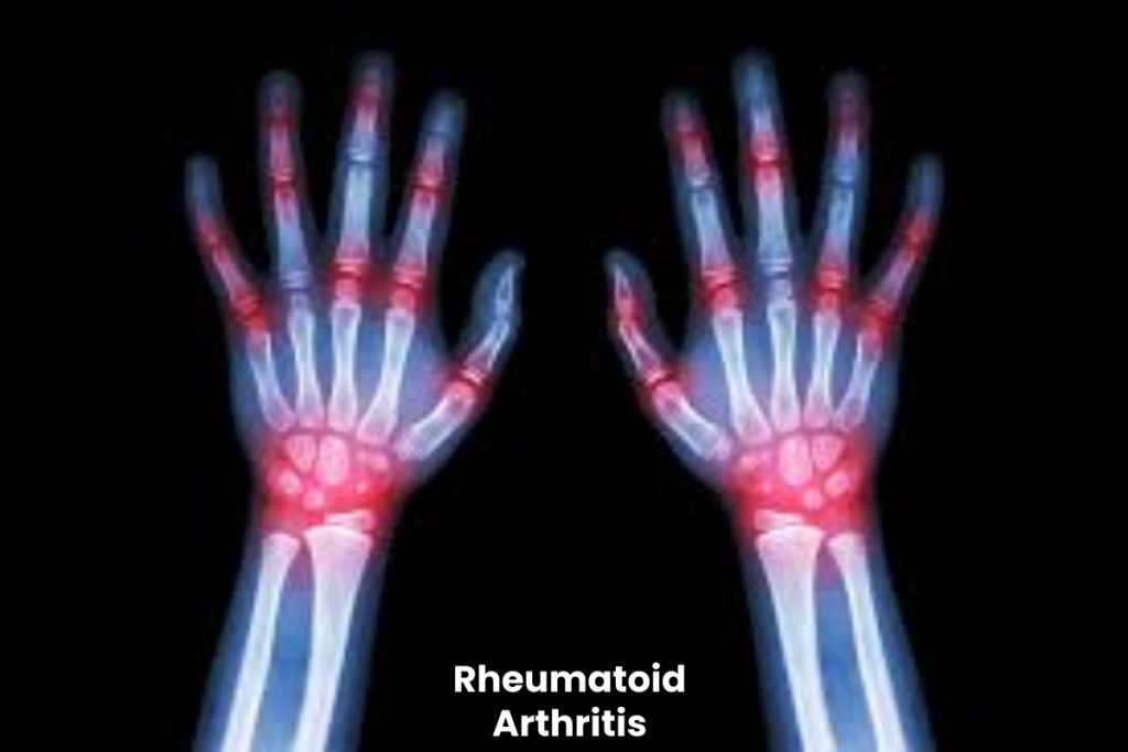 Rheumatoid Arthritis Write For Us