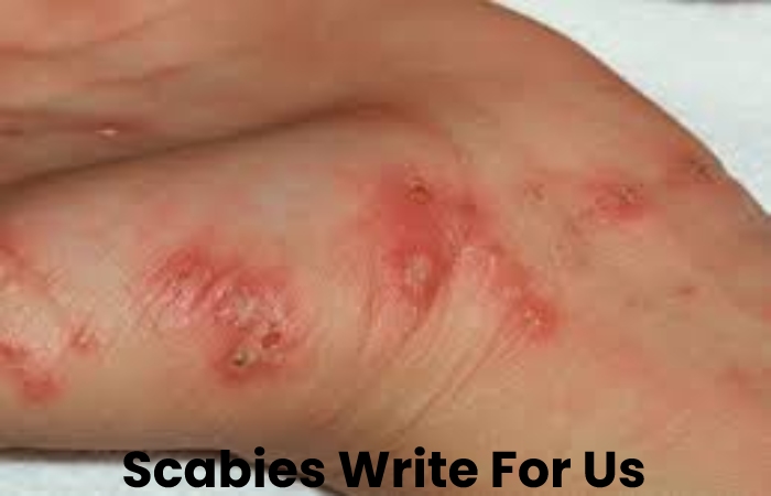 Scabies Write For Us