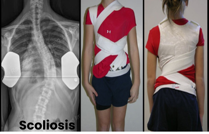 Scoliosis Write For Us