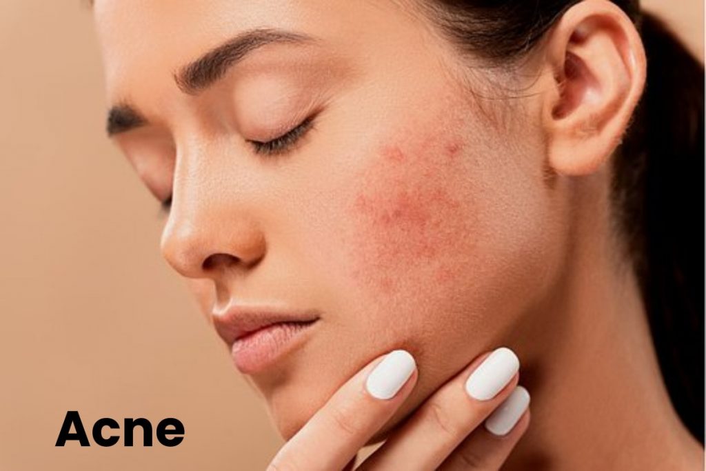 Acne Write For Us