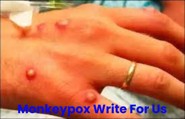 Monkeypox Write For Us