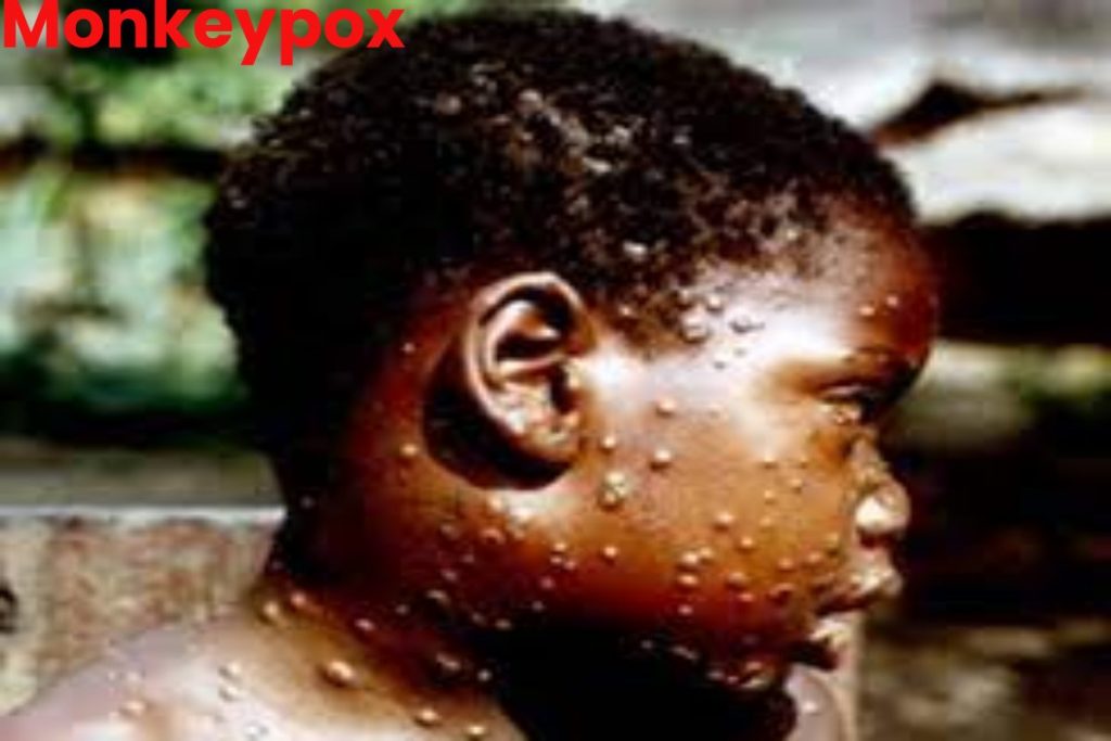Monkeypox Write For Us