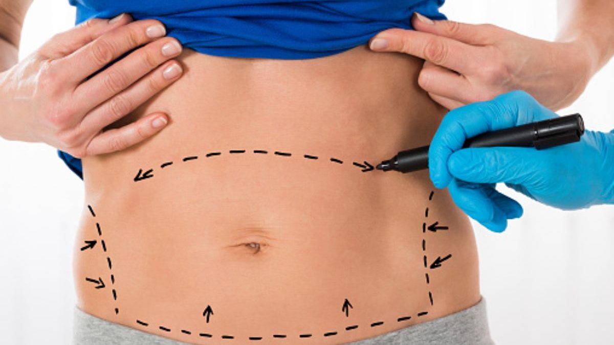 Are You An Ideal Candidate For Tummy Tuck Surgery?