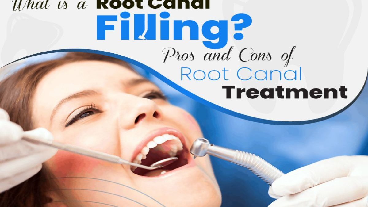 What Is A Root Canal Filling? Pros And Cons Of Root Canal Treatment