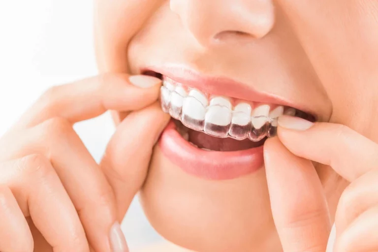 The Surprising Health Benefits of Teeth Aligners