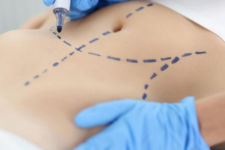 Liposuction Pubic Area: How to Deduce Mons Pubis Fat?