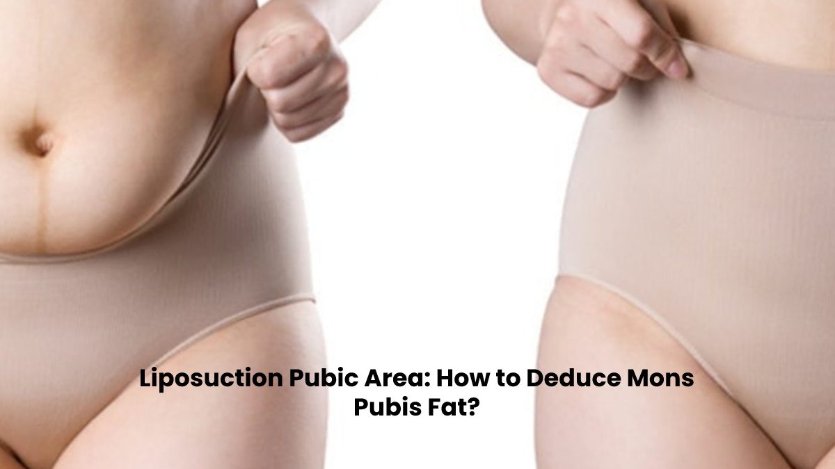 Liposuction Pubic Area: How to Deduce Mons Pubis Fat?