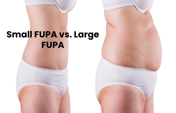 liposuction pubic area - Small FUPA vs. Large FUPA