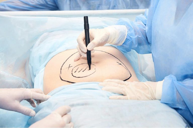 Thinking of Getting a Tummy Tuck? Here is What to Expect