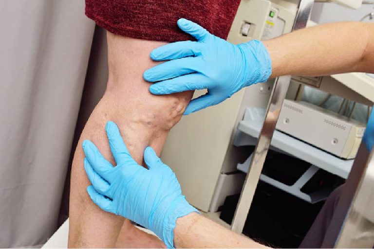 Varicose Veins – All You Need To Know