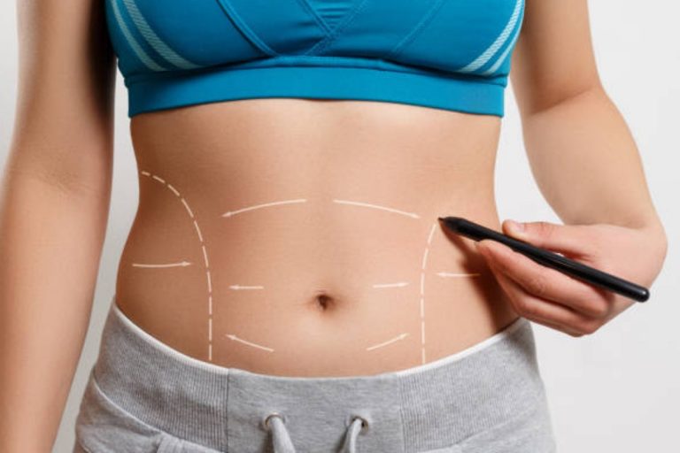 What Can I Expect During and After a Tummy Tuck?