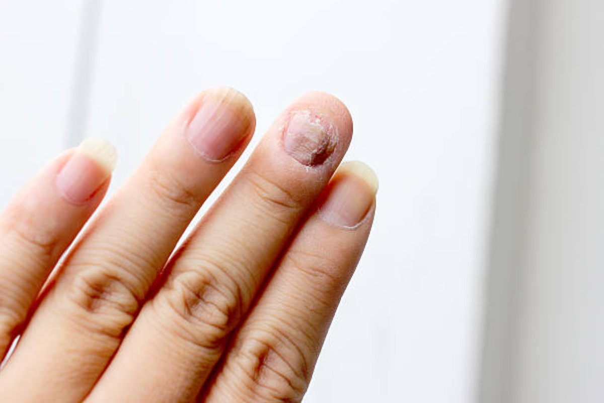 https://www.health4fitnessblog.com/nail-fungus-write-for-us/