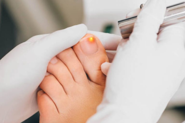 5 Ways to Treat Toenail Fungus