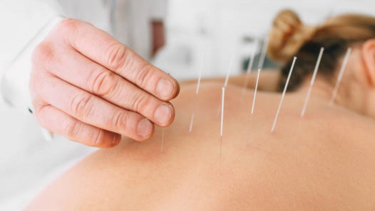Here is what You Should Know About Acupuncture Therapy