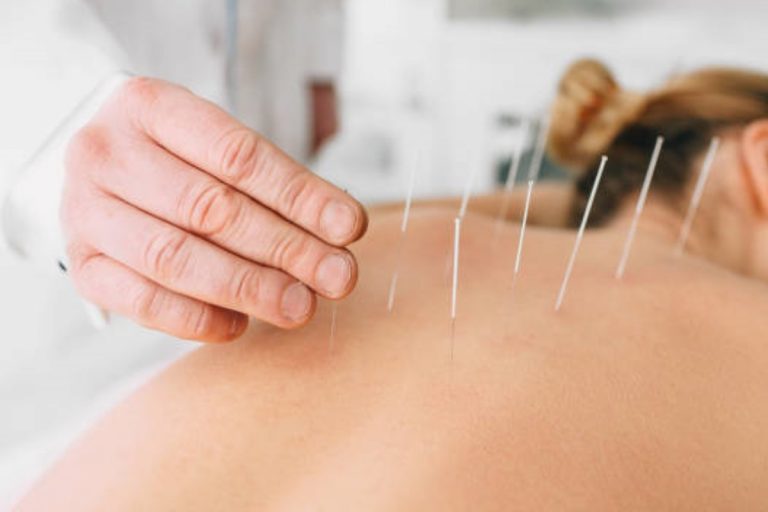 Here is what You Should Know About Acupuncture Therapy