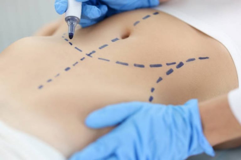 Liposuction
