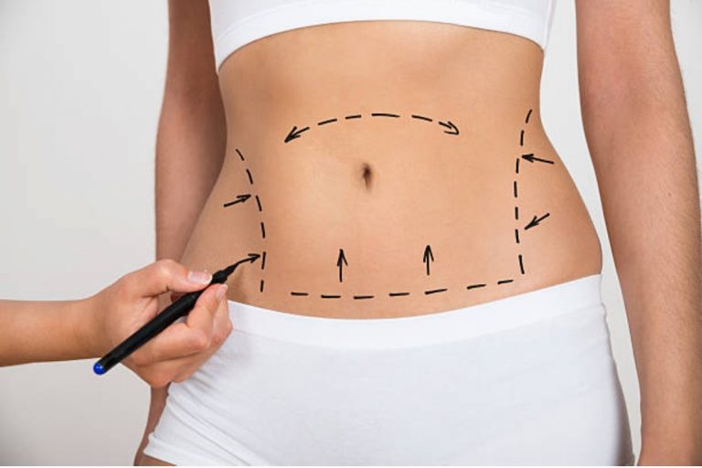 What You Need to Know About Liposuction Recovery Time