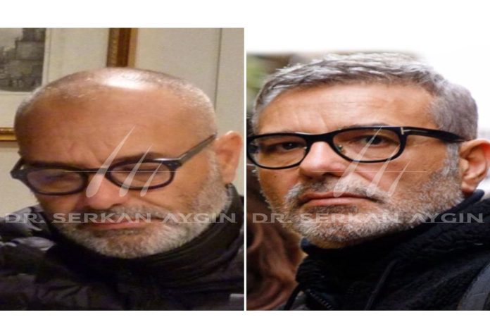 hair transplant