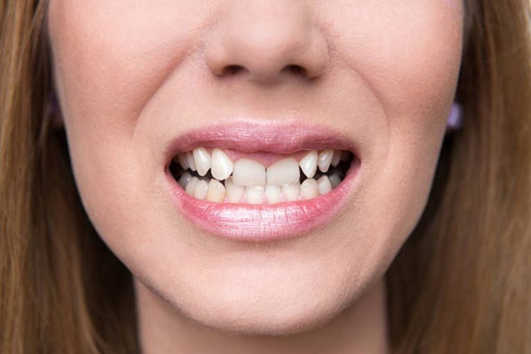 Buck Teeth: Understanding and Addressing Protruding Front Teeth