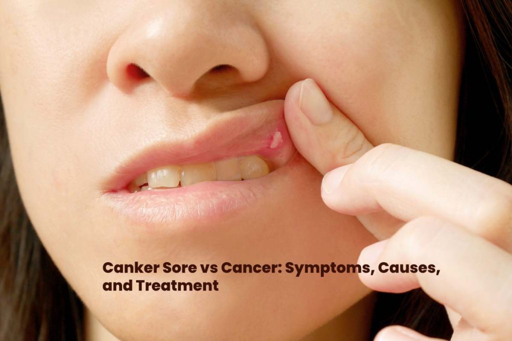 canker sore vs cancer