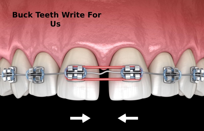 Buck Teeth