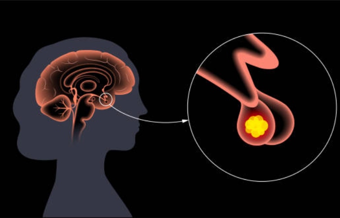 Hypophysectomy