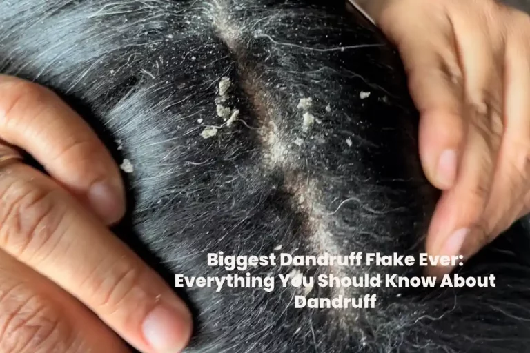 Biggest Dandruff Flake Ever: Everything You Should Know About Dandruff