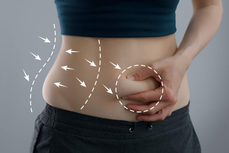 Exploring Your Options for Tummy Tuck Surgery